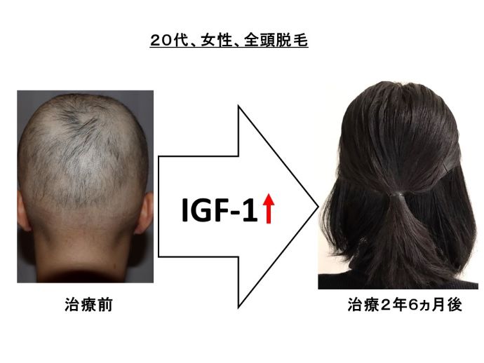 円形脱毛症　病院